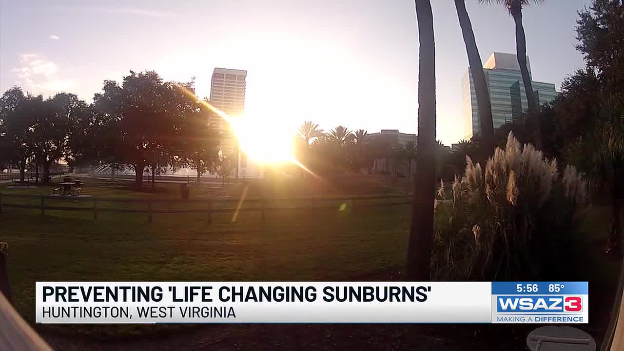 Skincare specialist weighs in on preventing ‘life changing sunburns’