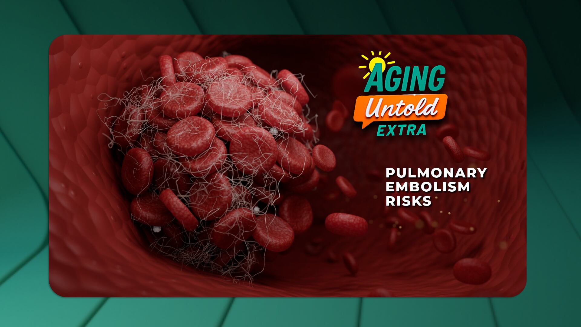 Pulmonary embolisms: Risks, warning signs and how to lower your chances