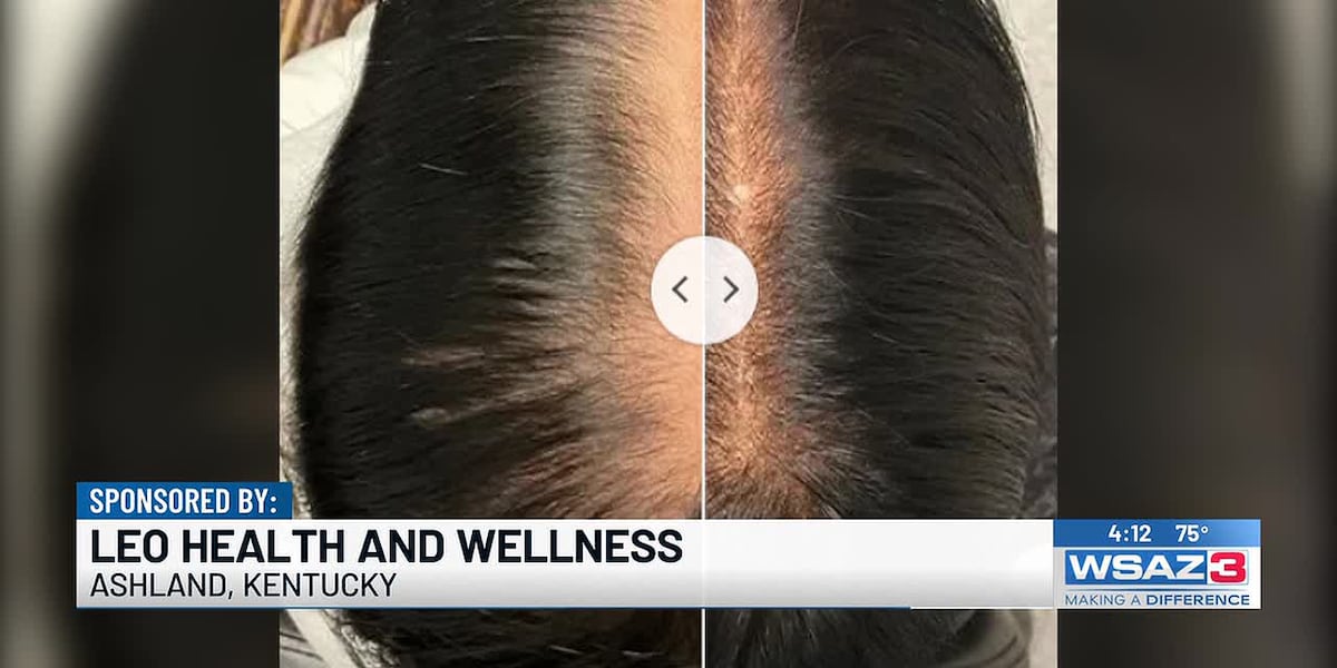Managing Hair Loss | LEO Health and Wellness
