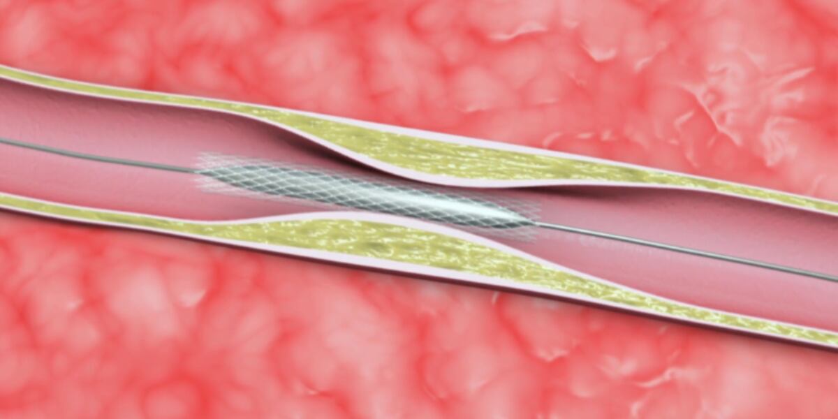 Looking at a Roto-Rooter type procedure for the heart